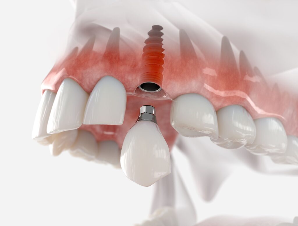 Rendering of dental implant in upper arch of translucent jaw